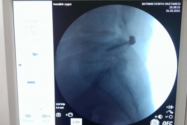 Percutaneous Facet